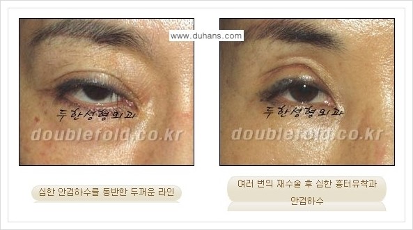 [두한성형외과 경쟁력 쌍꺼풀 재수술, 극한 재수술] - [망친 눈(쌍꺼풀) 복원수술과 일반 쌍꺼풀 재수술과의 차이점] 관련 이미지 2