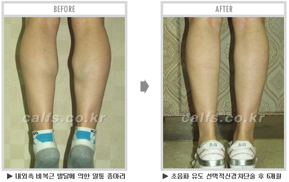 [종아리성형 두한성형외과] - [종아리수술에 대한 자주하는 질문과 답변 모음] 관련 이미지 60