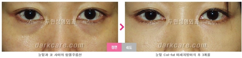 [두한성형외과 다크서클] - [다크서클 전후사진 검증] 관련 이미지 87