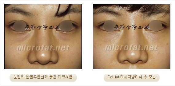 ​[두한성형외과 경쟁력 눈밑성형 리더] - [눈밑 다크써클의 증상, 원인, 종류, 치료방법 안내] 관련 이미지 33