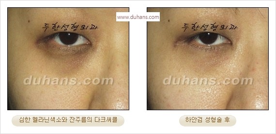[두한성형외과 경쟁력 안검성형] - [눈밑주름 제거수술] 관련 이미지 18