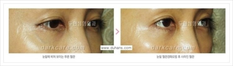 [두한성형외과 경쟁력 눈밑성형 리더] - [다크써클 원인, 종류, 증상, 치료법, 치료 실패의 원인] 관련 이미지 29