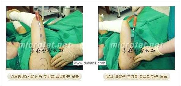 [두한성형외과 경쟁력 바디성형] - [하복부, 팔뚝, 허리선, 허벅지, 엉덩이 간편지방흡입술] 관련 이미지 9