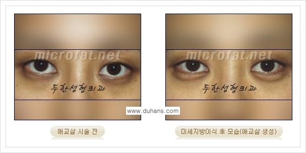 [두한성형외과 경쟁력 눈밑성형] - [애교살과 다크써클과의 관계] 관련 이미지 14