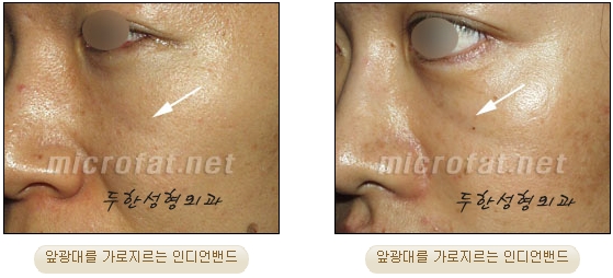 [두한성형외과 자가지방이식] - [인디언주름] 관련 이미지 4