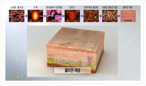 [두한성형외과 경쟁력 주름성형] - [HIFU 초음파 리프팅 주름교정술 안내 2.] 관련 이미지 14