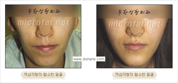 [두한성형외과 경쟁력 미세지방이식] - [타 병원에서 볼살 지방이식 이후 부작용 교정 방법 안내] 관련 이미지 2