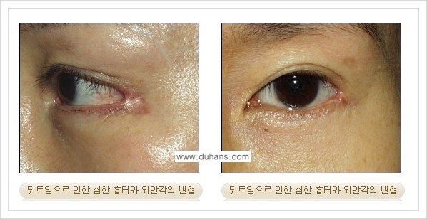 [두한성형외과 경쟁력 쌍꺼풀 재수술, 극한 눈재수술] - [뒤트임 수술의 부작용 및 교정 방법 안내] 관련 이미지 3