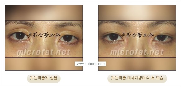 [두한성형외과 경쟁력 미세지방이식] - [꺼진(함몰된) 윗눈꺼풀 미세지방이식] 관련 이미지 14