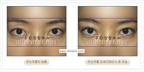 [두한성형외과의 경쟁력 미세지방이식] - [꺼진 눈꺼풀(윗눈꺼풀 함몰) 미세지방이식 안내] 관련 이미지 9