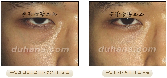 [두한성형외과 지방이식] - [눈밑 다크써클] 관련 이미지 40