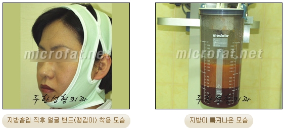 [Duhan Plastic Surgery Liposuction] - [Facial Liposuction] image 9