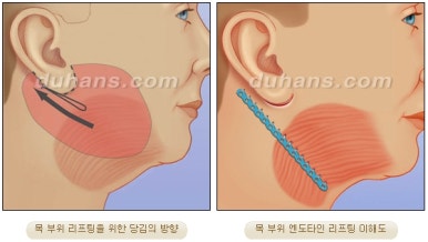 [Duhan Plastic Surgery Wrinkle Improvement] - [Wrinkle Lifting] image 17