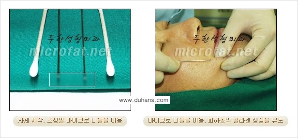[두한성형외과] - [두한 지방이식의 자부심 콜펫(Col-fat)지방이식] 관련 이미지 3
