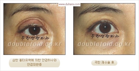 [두한성형외과 경쟁력 눈성형] - [극한 재수술, 함몰된 눈꺼풀 라인교정, 안검하수(졸리운 눈매)] 관련 이미지 9