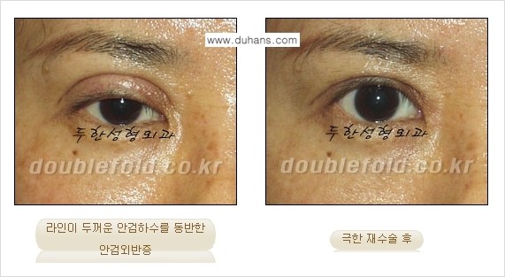[두한성형외과 NO.1 경쟁력 눈성형] - [일반 쌍꺼풀 재수술과 극한 눈(쌍꺼풀) 재수술과의 차이점] 관련 이미지 13