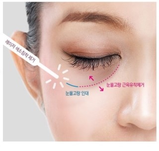 [두한성형외과 무한 경쟁력 눈밑성형] - [애교살 시술 1.] 관련 이미지 10