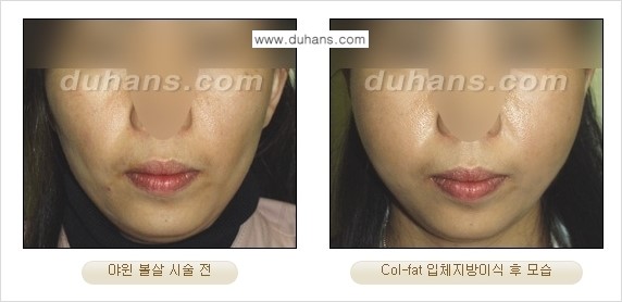 [두한성형외과 경쟁력 미세지방이식]-[Col-fat 입체지방이식 사례 안내] 관련 이미지 12