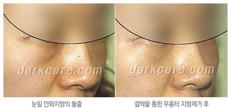 [두한성형외과 눈밑성형] - [무흉터 눈밑지방제거] 관련 이미지 6