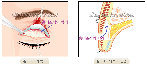 [두한성형외과 경쟁력 눈성형] - [완전절개법, 부분절개법, 눈꺼풀 함몰되었을 경우 재수술 과정에 대한 안내] 관련 이미지 6