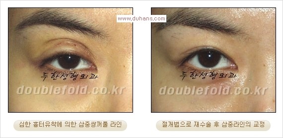 [두한성형외과 경쟁력 쌍꺼풀 재수술] - [삼중(세겹) 쌍꺼풀 라인, 눈꺼풀이 함몰된 삼중(세겹) 쌍꺼풀 라인 교정] 관련 이미지 6