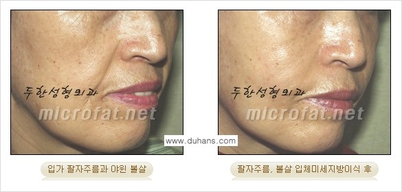 [두한성형외과 경쟁력 미세지방이식] - [두한성형외과 Col-fat(콜펫) 지방이식으로 교정이 가능한 부위 안내] 관련 이미지 9