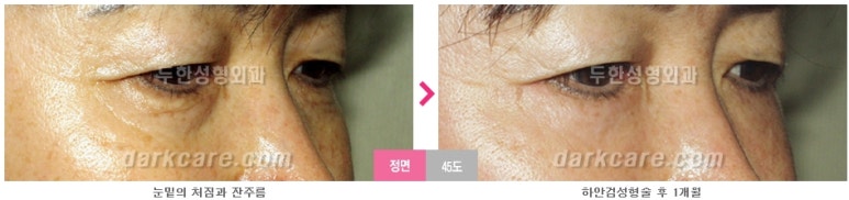 [두한성형외과 다크서클] - [다크서클 전후사진 검증] 관련 이미지 120