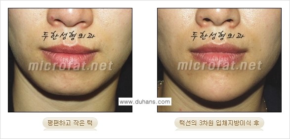 [두한성형외과 경쟁력 미세지방이식] - [얼굴 윤곽 무턱교정 안내 ②] 관련 이미지 9