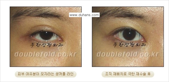 [두한성형외과 쌍꺼풀 재수술] - [피부 여유분이 부족해서 토안증이 발생한 경우] 관련 이미지 2