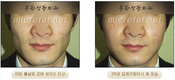 얼굴지방이식 두한성형외과 - 볼지방이식 관련 이미지 31