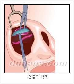 DuHan Plastic Surgery Revision Rhinoplasty - AlloDerm Nose Surgery, SureDerm Nose Surgery image 7