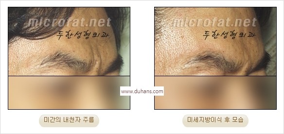 [두한성형외과 경쟁력 동안성형 리더] - ​[미간주름, 이마주름, 안검성형, 이마거상술, 눈썹거상술] 관련 이미지 7