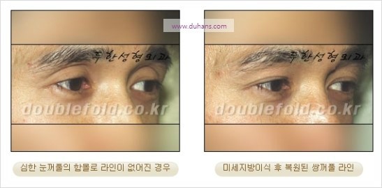 [두한성형외과 경쟁력 눈성형] - [쌍꺼풀 재수술 과정과 쌍꺼풀 재수술 실패의 원인, 쌍꺼풀 재수술의 성공 요건] 관련 이미지 48