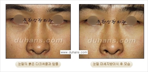 [두한성형외과 경쟁력 미세지방이식] - [다크써클 & 눈밑주름 미세지방이식 3.] 관련 이미지 14