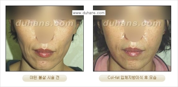 [두한성형외과 경쟁력 미세지방이식]-[Col-fat 입체지방이식 사례 안내] 관련 이미지 16