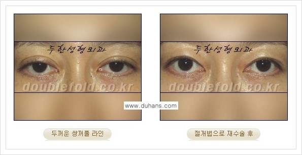 [두한성형외과 경쟁력 쌍꺼풀 재수술] - [두껍고 어색한 라인 교정하는 방법 안내 2.] 관련 이미지 7