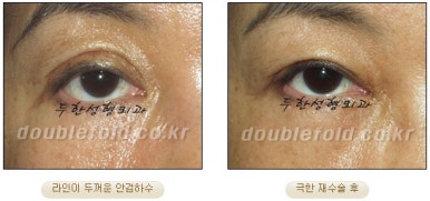 쌍꺼풀수술 두한성형외과 - 쌍커풀재수술의 문제점 관련 이미지 20
