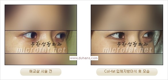 [두한성형외과 경쟁력 지방이식] - [두한 자가지방이식 클리닉 안내]​ 관련 이미지 49