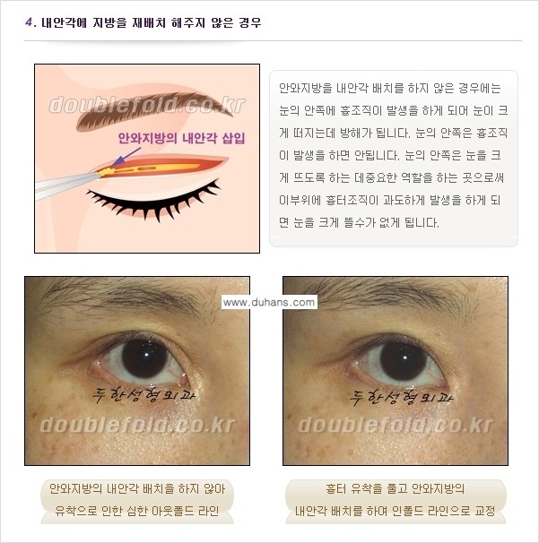 [두한성형외과 경쟁력 쌍꺼풀 재수술(눈재수술)] - [쌍꺼풀 재수술(눈재수술)의 실패의 원인 분석] 관련 이미지 5