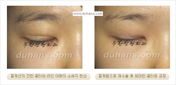 [두한성형외과 경쟁력 쌍꺼풀 재수술, 극한 눈재수술] - [절개법 수술후 쌍꺼풀 흉터선이 진한 경우의 교정 안내] 관련 이미지 2