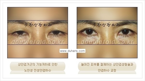 [두한성형외과 경쟁력 쌍꺼풀 재수술(극한 재수술)] - [안검하수(졸리운 눈매) 교정 안내 1.] 관련 이미지 13