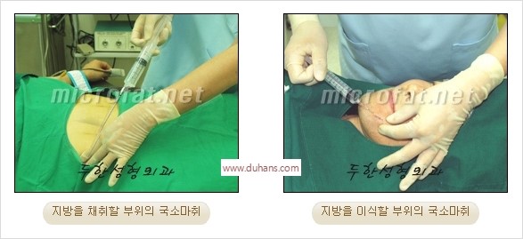 [두한성형외과 경쟁력 미세지방이식] - [타 병원의 지방이식 부작용 교정 - 정교한 마이크로 지방이식, 흡입 안내] 관련 이미지 24