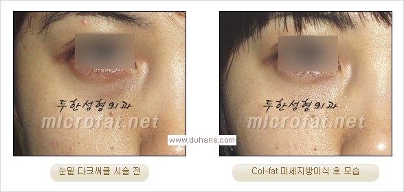 [두한성형외과 경쟁력 지방이식] - [두한 자가지방이식 클리닉 안내]​ 관련 이미지 51