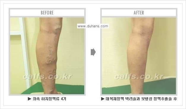 [두한성형외과 경쟁력 정맥류 치료] - [하지정맥류 사진 자료 안내 1.] 관련 이미지 12