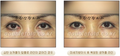 [두한성형외과 눈성형] - [풀린 쌍커풀 재수술] 관련 이미지 11
