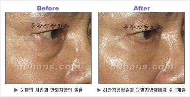 [두한성형외과 안검성형] - [상안검, 하안검] 관련 이미지 34