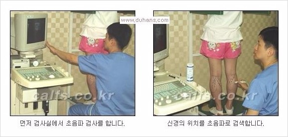[두한성형외과 Dr. 컬럼 - 타 병원의 종아리 퇴축술 이후 문제가 발생한 경우] 관련 이미지 3