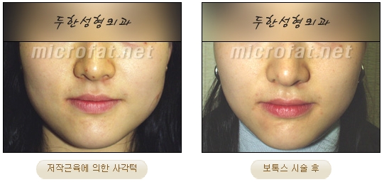 [두한성형외과 보톡스] - [사각턱 보톡스 시술 안내] 관련 이미지 14