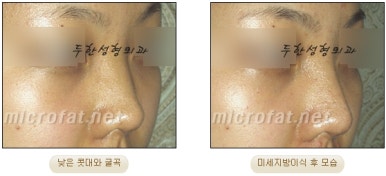 [Duhan Plastic Surgery Facial Fat Grafting] - [Fat Grafting Rhinoplasty] image 19
