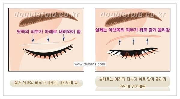 [두한성형외과 경쟁력 쌍꺼풀 재수술] - [두껍고 어색한 라인 교정하는 방법 안내 1.] 관련 이미지 9